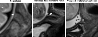 Magnetic resonance imaging of the supra-cervical fetal membrane detects an increased risk of prelabor rupture of membranes